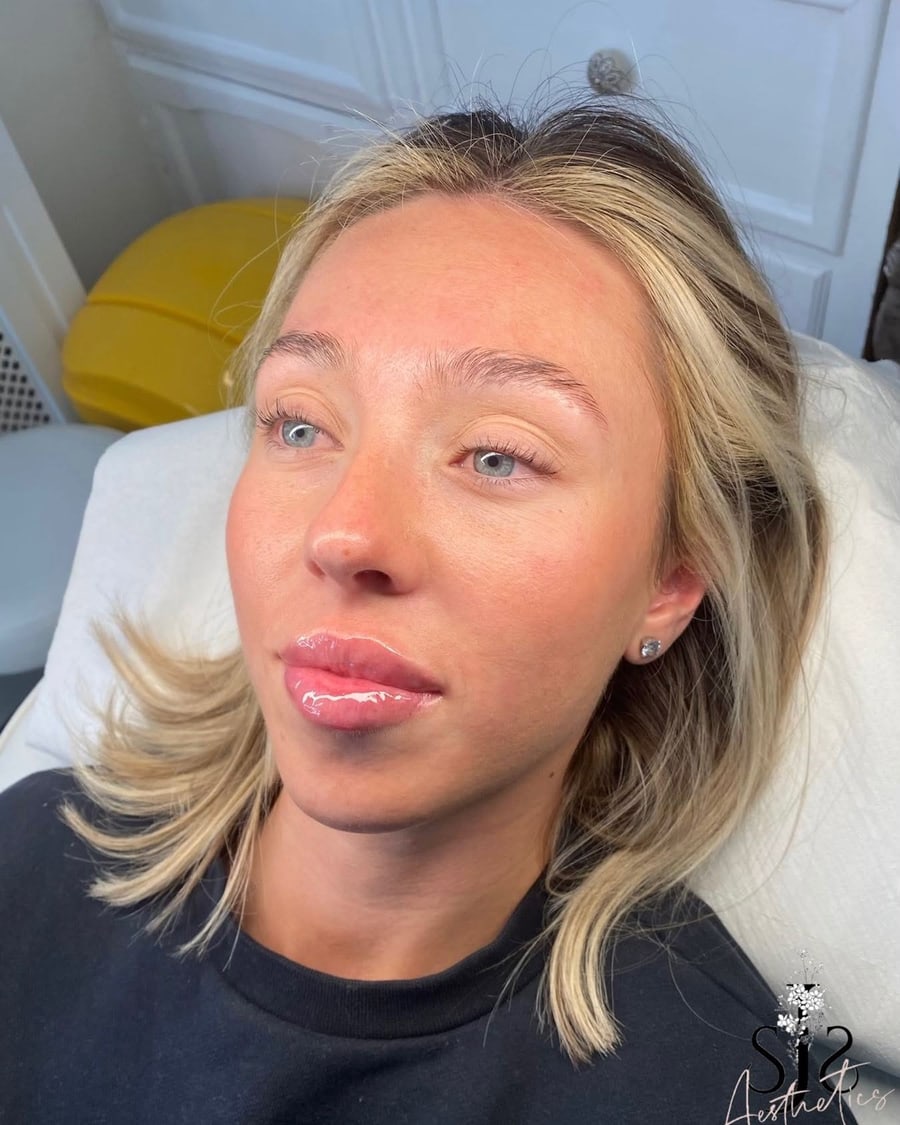Lip filler result by Sara at SJS Aesthetics on the Wirral