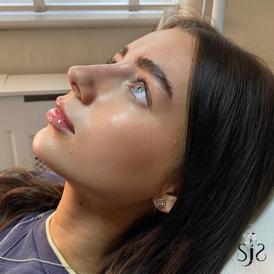 Lip filler profile result by Sara at SJS Aesthetics on the Wirral