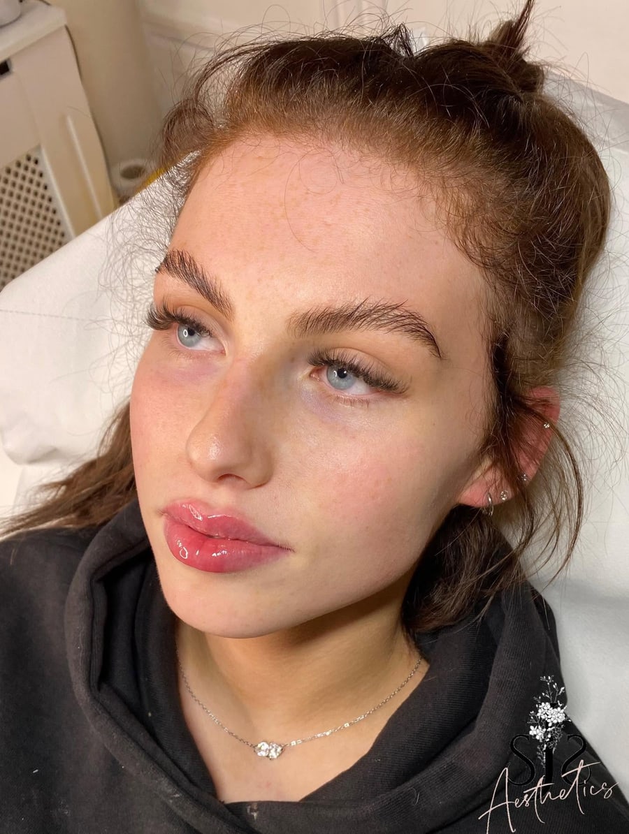Lip filler result showing natural shape by Sara at SJS Aesthetics